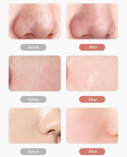 UltrasonicPEN®️ | Piel rejuvenecida, exfoliada e hidratada ✨