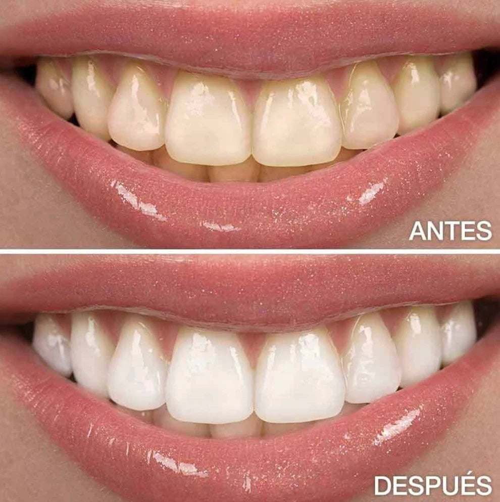 Gel V34® - Blanqueamiento Rápido